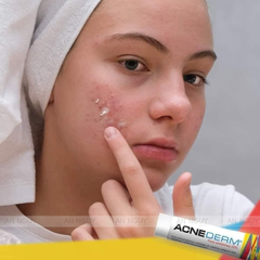 Kem Trị Mụn, Mờ Thâm Acne-Derm Kwas Azelainowy 20% 20gr