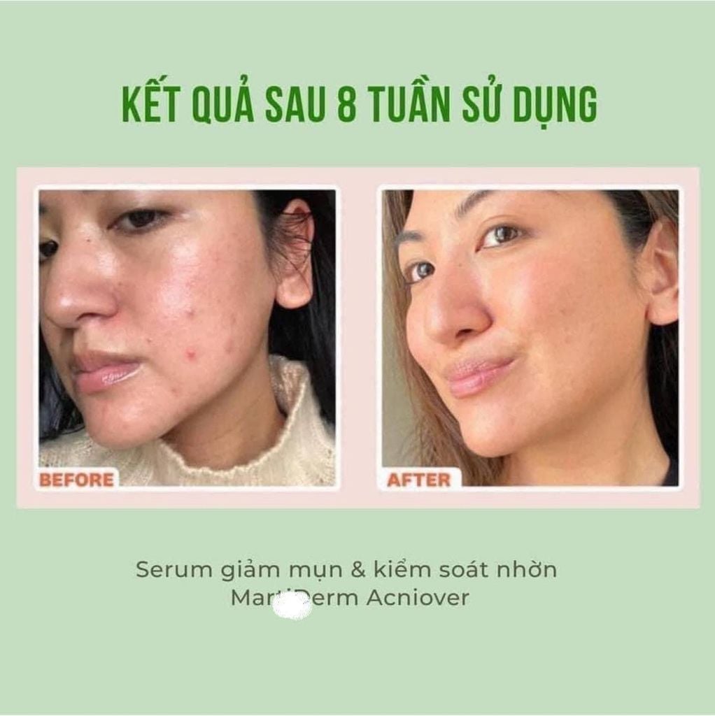 Tinh Chất Giảm Mụn & Kiểm Soát Nhờn Martiderm Acniover Serum 30ml