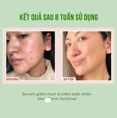 Tinh Chất Giảm Mụn & Kiểm Soát Nhờn Martiderm Acniover Serum 30ml