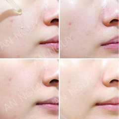 Tinh Chất Trị Mụn Some By Mi AHA-BHA-PHA 30 Days Miracle Serum 50ml