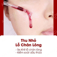 Tinh Chất So'Natural Red Peel Tingle Serum Giúp Tái Tạo Làn Da, Giảm Mụn