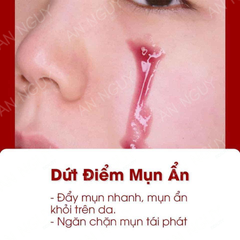 Tinh Chất So'Natural Red Peel Tingle Serum Giúp Tái Tạo Làn Da, Giảm Mụn