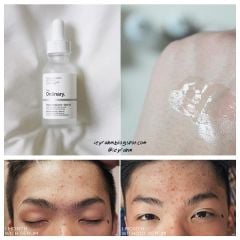 Serum The Ordinary Niacinamide 10% + Zinc 1% Trị Mụn, Giảm Thâm 30ml