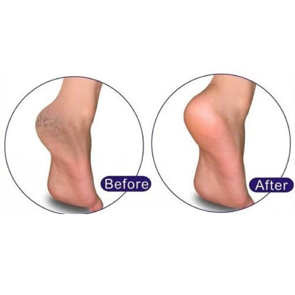 Kem Trị Nứt Gót Chân KPEM 50ml