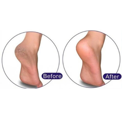 Kem Trị Nứt Gót Chân KPEM 50ml