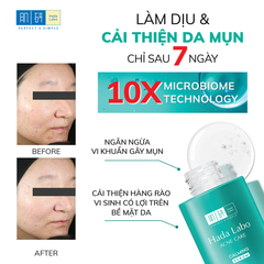 Tinh Chất Hada Labo Acne Care Soothe & Improve Acne-Prone Skin Calming Serum Làm Dịu Da Mụn 30ml