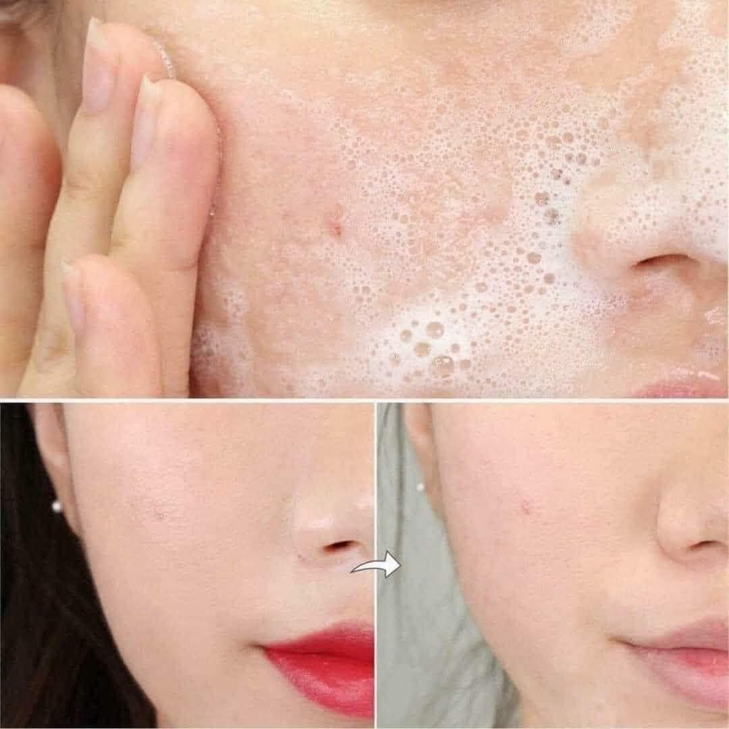 Sữa Rửa Mặt Vichy Normaderm Intensive Purifying Cleanser Dành Cho Da Mụn, Nhạy Cảm 50ml