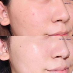 Tinh Chất Cấp Nước Mesoestetic HA Densimatrix Serum Dưỡng Ẩm Chống Lão Hóa Da 30ml