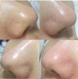 Dung dịch ủ mụn MEDI-PEEL Extra Super 9+