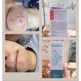  Ngăn Ngừa Mụn Trứng Cá Hylamend Gel Cải Thiện Và Phục Hồi Da Sau Mụn Làm Nhẹ Dịu Cho Da 