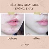  Kem Mụn ACNETlN-A Thái Lan Dưỡng Trẻ Hóa Da Hỗ Trợ Giảm Mụn Ẩn Mụn Thâm Tuýp 10g 