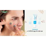  Kem Ngăn Ngừa Mụn Trứng Cá Hylamend Gel Cải Thiện Và Phục Hồi Da Sau Mụn Làm Nhẹ Dịu Cho Da 