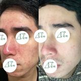  Ngăn Ngừa Mụn Trứng Cá Hylamend Gel Cải Thiện Và Phục Hồi Da Sau Mụn Làm Nhẹ Dịu Cho Da 