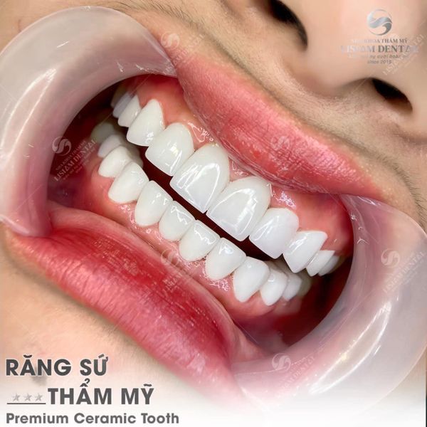  Răng Sứ Premium Ceramic 