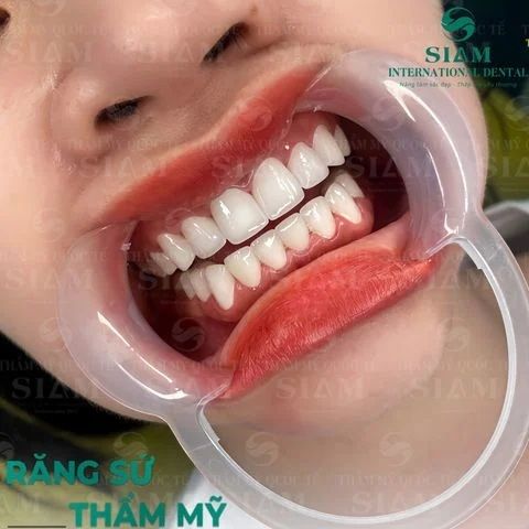  Bọc răng sứ Orodent Bleach 