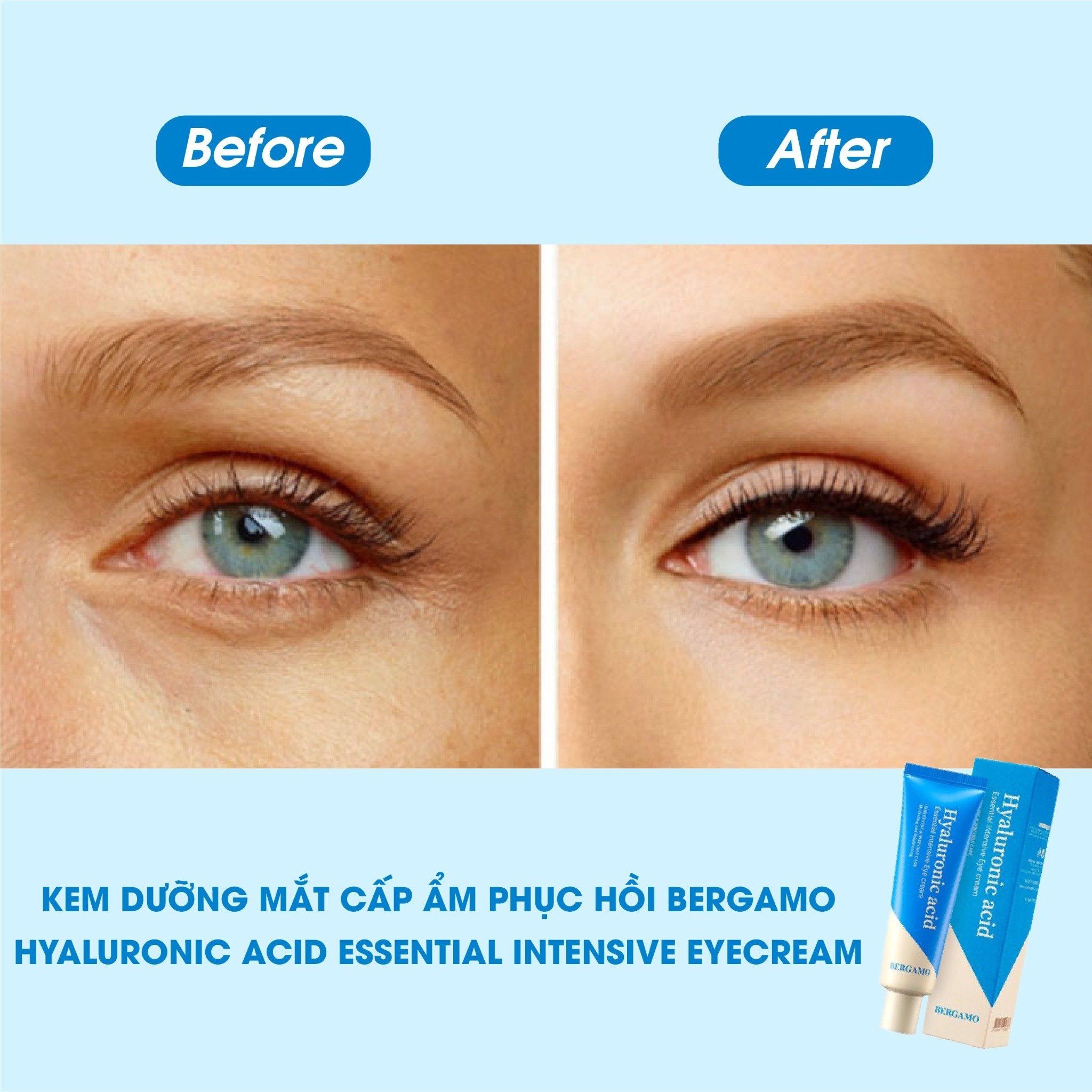 KEM DƯỠNG MẮT CẤP ẨM HỖ TRỢ PHỤC HỒI BERGAMO HYALURONIC ACID ESSENTIAL INTENSIVE EYE CREAM 100G
