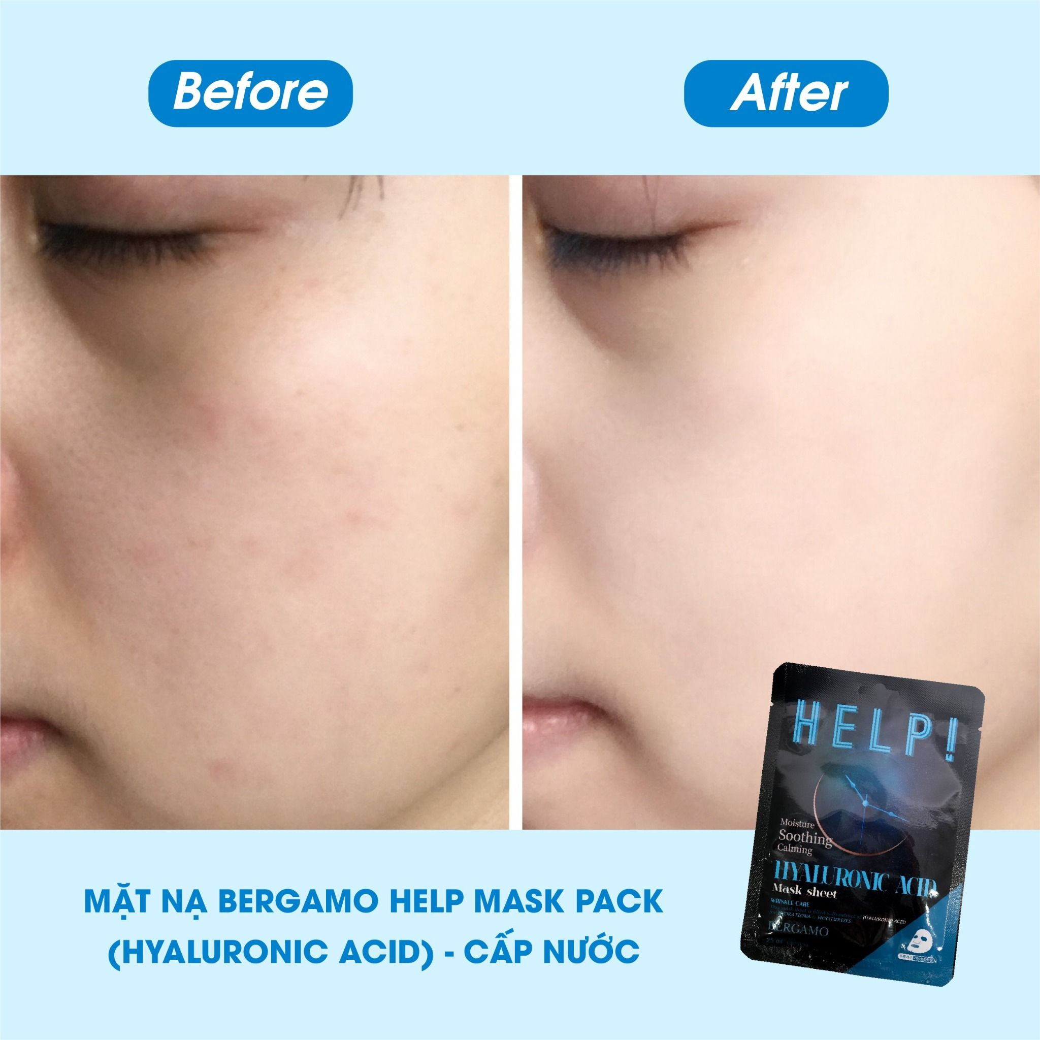 MẶT NẠ BERGAMO HELP MASK PACK HYALURONIC ACID - CẤP NƯỚC