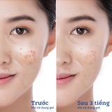  Gel Chấm Mụn Blissberry Pureskin Acne Fixer K21 15ml 