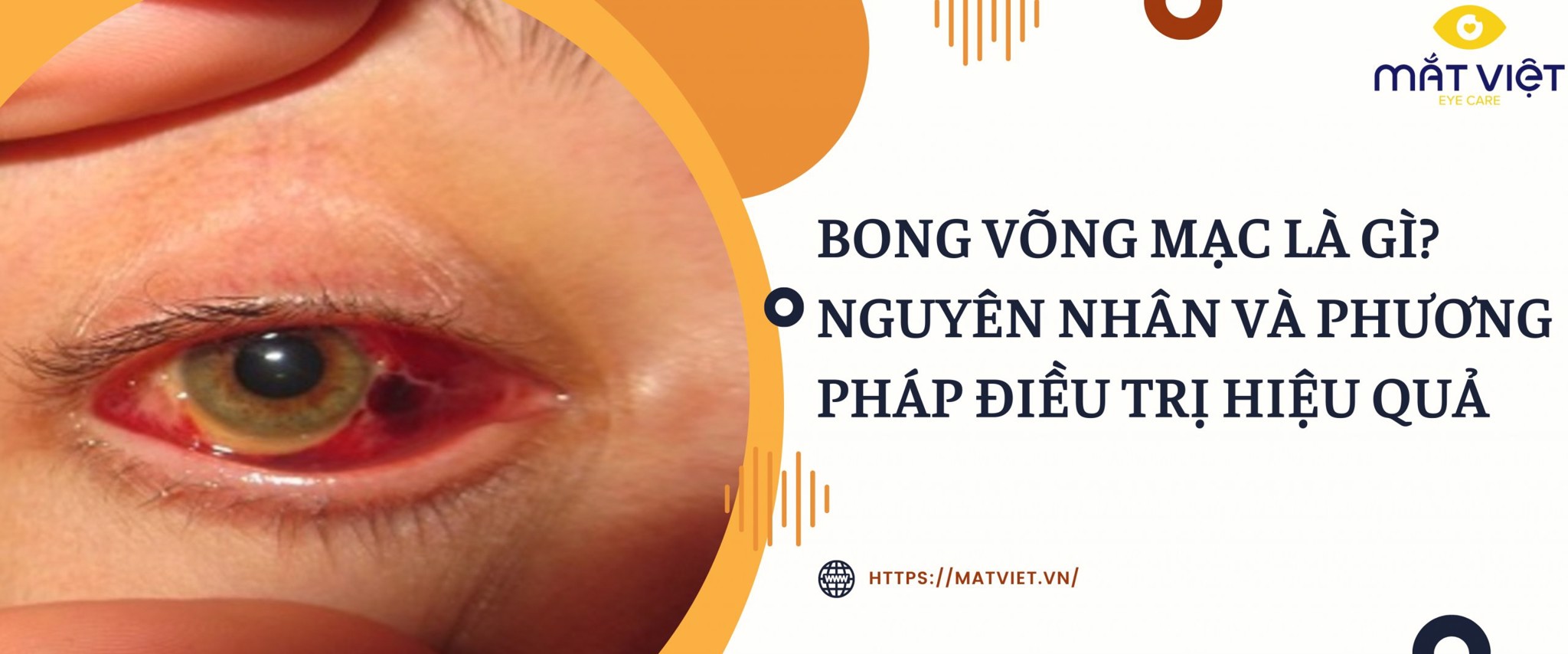 Bong võng mạc