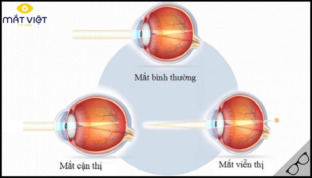 Tìm hiểu cận thị và viễn thị