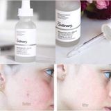  (NEW) Tinh Chất Sáng Da, Mờ Thâm Mụn The Ordinary Niacinamide 10% + Zinc 1% 