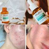  Tinh Chất Ngừa Mụn Mờ Thâm Balance Active Formula Niacinamide 15% 30ml 