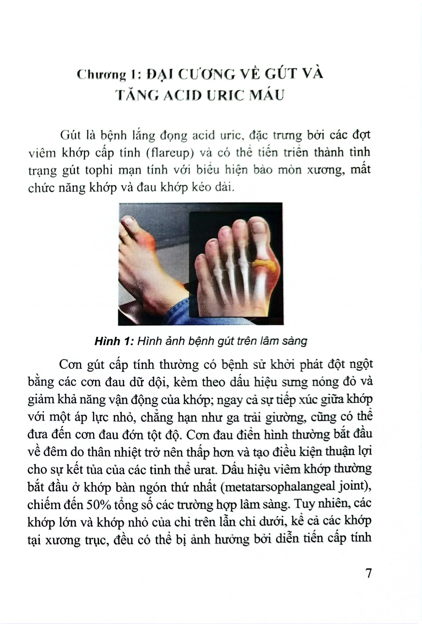 Bệnh Gút Từ Khoa Học Cơ Sở Đến Thực Hành Lâm Sàng - PGS.TS. Huỳnh Quang Thuận, TS. Lê Quốc Tuấn
