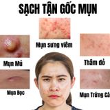  Bộ Tri Mụn ẩn , Mụn trứng cá, giảm mờ thâm Doctor Care dịu nhẹ dành cho nam nữ da dầu mụn (01 kem 30g + sữa rửa mặt 130g) 