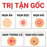  Bộ Tri Mụn ẩn , Mụn đầu đen, Mụn thâm Doctor Care dịu nhẹ dành cho nam nữ da dầu mụn ( Serum 20ml + kem 30g +sữa rửa mặt 130g) ) 