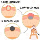  Bộ Tri Mụn ẩn, Mụn trứng cá, Giảm mờ thâm Doctor Care dịu nhẹ dành cho nam nữ da dầu mụn (Serum 20ml + sữa rửa mặt 130g) 