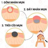  Bộ Tri Mụn ẩn , Mụn đầu đen, Mụn thâm Doctor Care dành cho nam nữ da dầu mụn ( Serum 20ml + mặt nạ 50g + toner 200ml + sữa rửa mặt 130g ) 