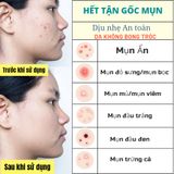  Bộ Tri Mụn ẩn , Mụn trứng cá, giảm mờ thâm Doctor Care dịu nhẹ dành cho nam nữ da dầu mụn ( Serum 20ml + kem 30g +Toner 200ml+ sữa rửa mặt 130g) 