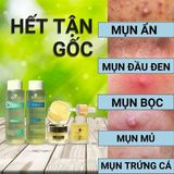  Bộ Tri Mụn ẩn ,Mụn đầu đen,Mụn thâm Doctor Care (serum20l+ kem3g+ tonner200ml+tay trang200ml ) 