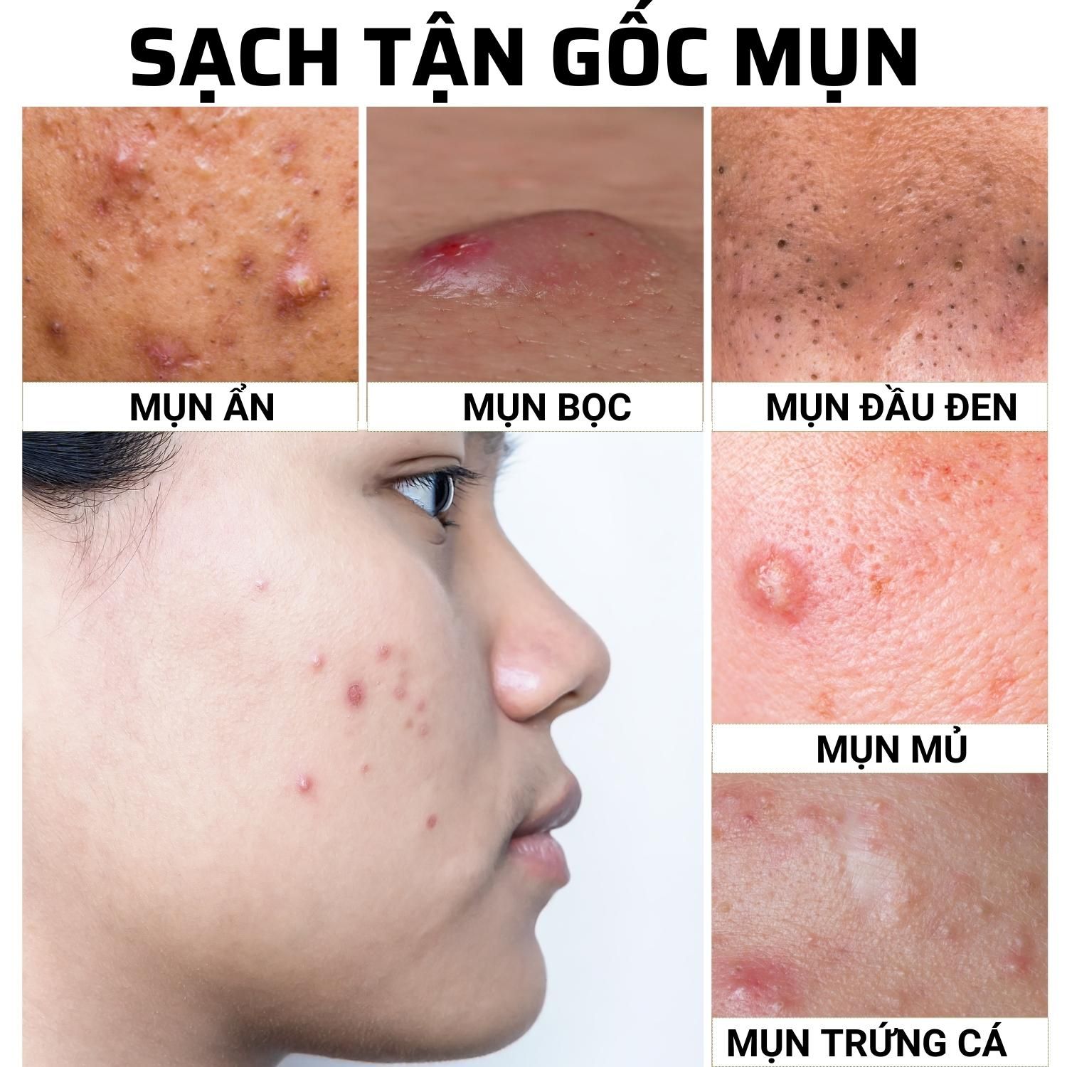  Serum Trị Mụn ẩn, mụn đầu đen cho da dầu tuổi dậy thì Doctor care 