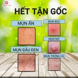  Bộ Tri Mụn ẩn , Mụn đầu đen, Mụn thâm Doctor Care (serum+ kem+ tonner+tay trang + mặt nạ + sữa rửa mặt ) 