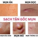  Kem Doctor care sạch mụn tận gốc mờ thâm sạm dưỡng trắng da căng bóng 