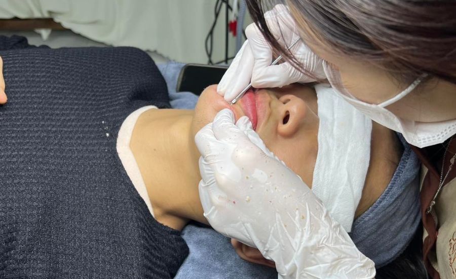  Chăm sóc da mụn cùng tinh chất mụn 