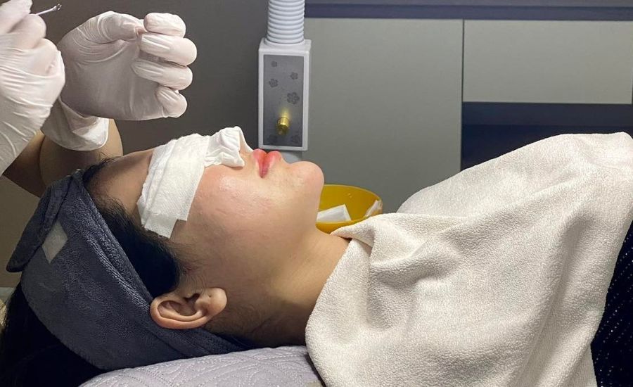  Điều trị mụn bằng tế bào gốc đặc trị 