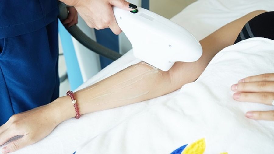  Triệt lông 1/2 tay 