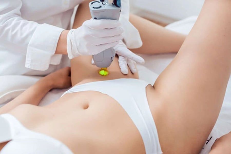  Triệt lông bikini 