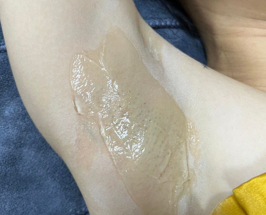  Triệt lông nách vĩnh viễn 