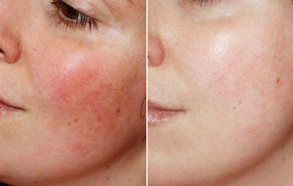 Serum Teana Giảm Đỏ, Viêm & Phục Hồi Da Nhạy Cảm 2ml x 10 Ống