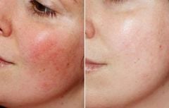 Serum Teana Giảm Đỏ, Viêm & Phục Hồi Da Nhạy Cảm 2ml x 10 Ống