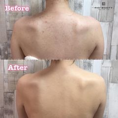 Xà Phòng Trị Mụn Lưng Pelican For Back Medicated Soap 135g