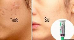 Kem GENTACIN Trị Sẹo Nhật 10g