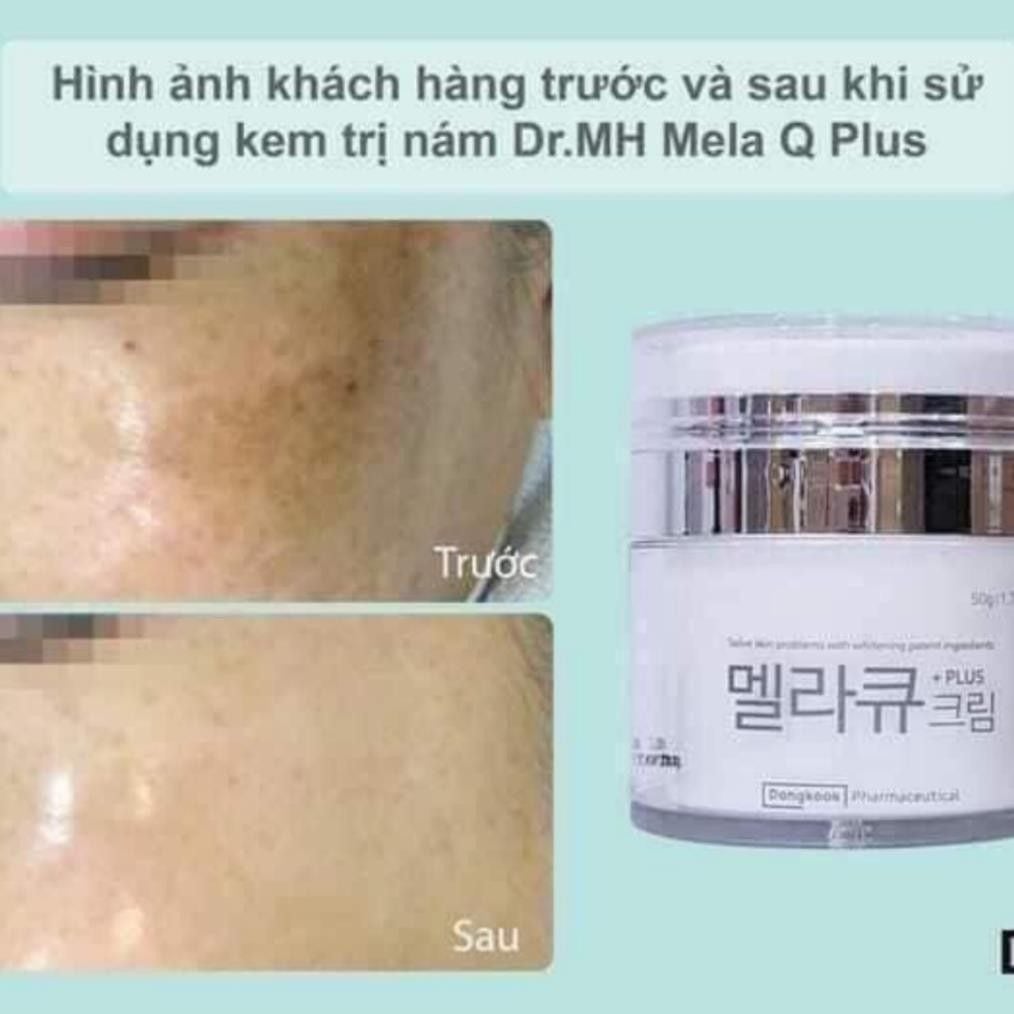 Kem trị Nám Tàn Nhang ban đêm Mela M 50gr
