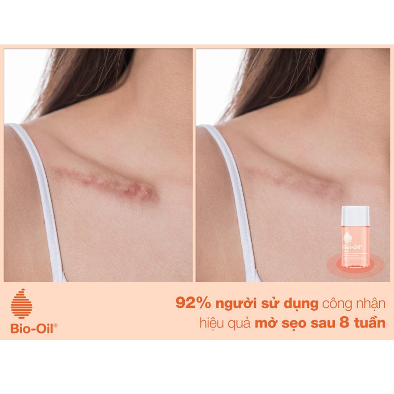 Dầu giảm rạn da và làm mờ sẹo Bio Oil Specialist Skincare Oil,  chai 60ml