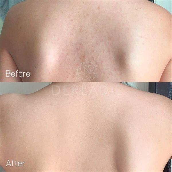 Xịt Trị Mụn, Mờ Thâm, Giảm Viêm Nang Lông Derladie Herbal Extract Body Solution Mist