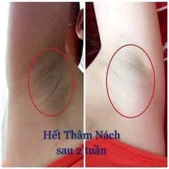Nuwhite - Kem trị thâm Nách/Bẹn/Mông H6 5ml USA (Ko tđ)