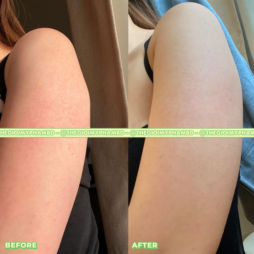 Xịt Trị Mụn, Mờ Thâm, Giảm Viêm Nang Lông Derladie Herbal Extract Body Solution Mist